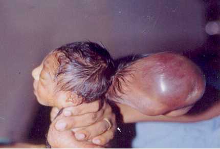 Meningocele Occipital